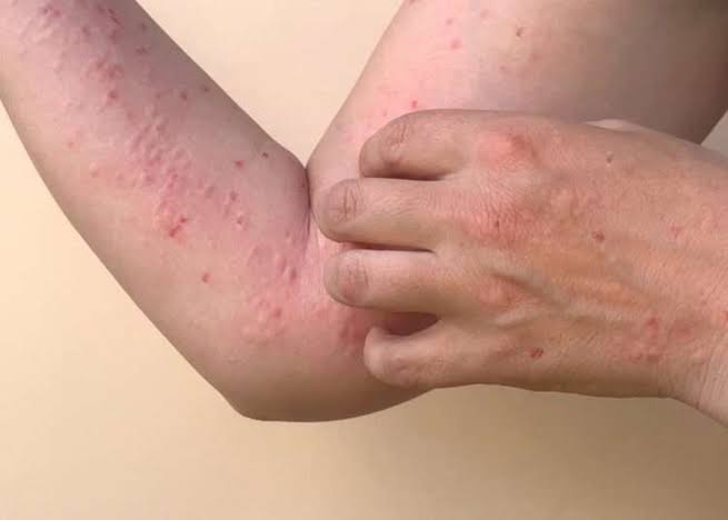 Virus Mpox Belum Terdeteksi Masuk ke Riau, Ini Saran Kadiskes