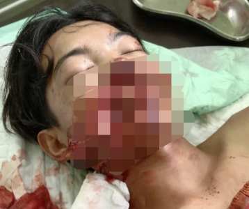 Warga Inhu Riau Diterkam Beruang, Kondisinya Mengerikan