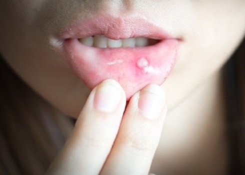 Anda Sering Sariawan, Ini Cara Mengobati dengan Bahan Alami, Berikut Caranya   