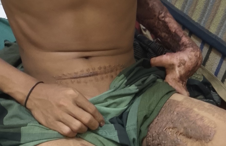 Cacat Akibat Kecelakaan Kerja, Adzan 22 Tahun Tuntut Hak ke PT Thaka Sukses Mandiri